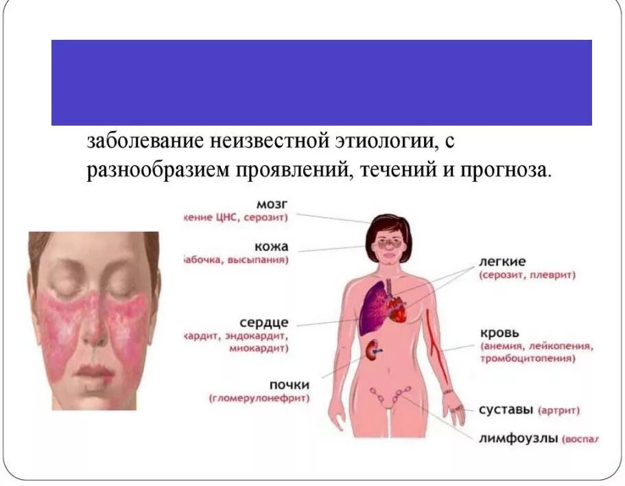 Смешанные заболевания соединительной. Эритематозная дискоидная красная волчанка. Болезни соединительной ткани красная волчанка. Клинические проявления системных заболеваний соединительной ткани.