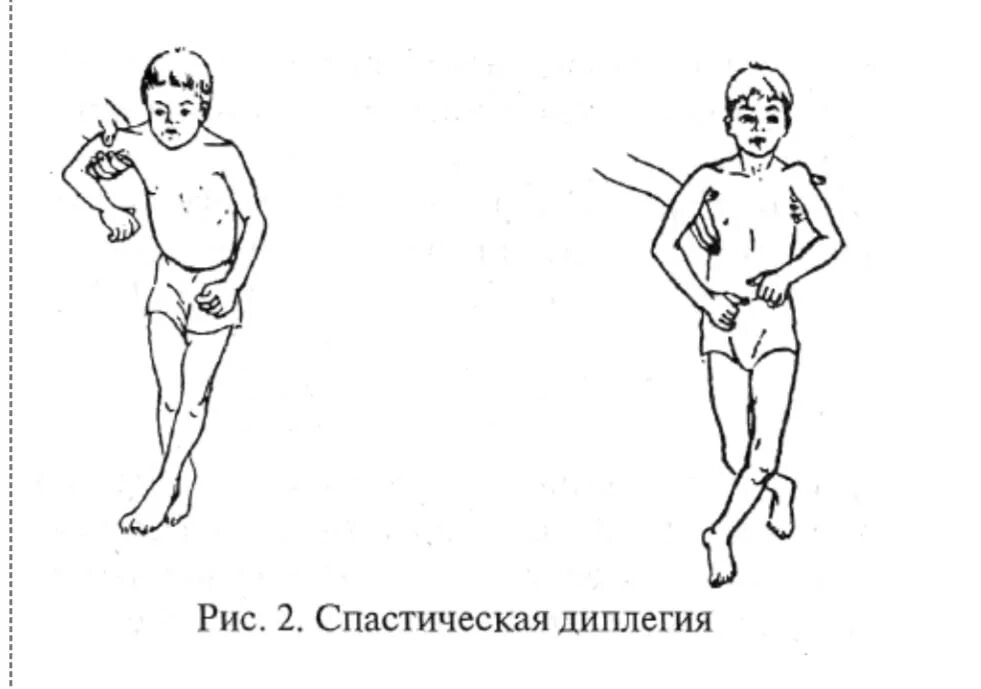 Дцп диплегия. Спастическая диплегия форма ДЦП. Спастическая форма ДЦП симптомы. Формы ДЦП болезнь Литтля. Спастический тетрапарез нижних конечностей.