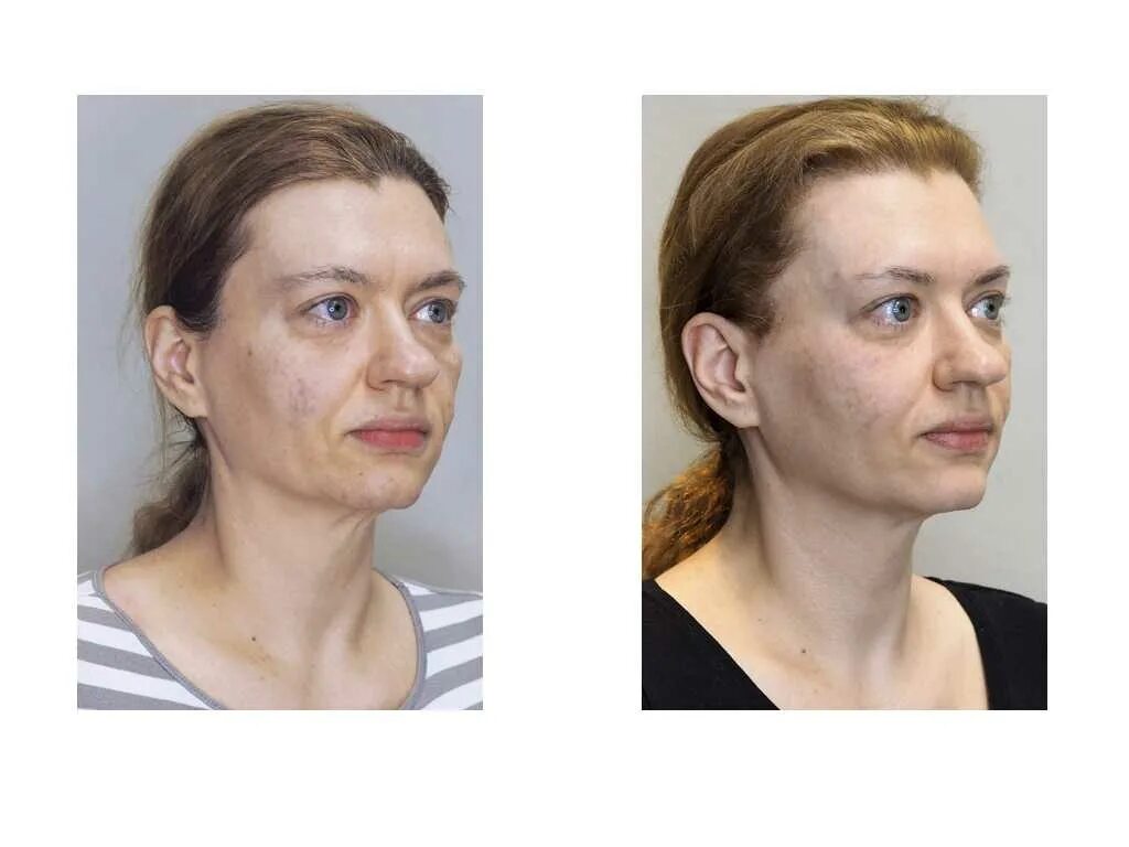 Лицо без брылей