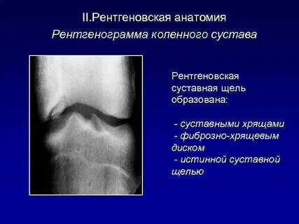 Неравномерная суставная щель коленного сустава