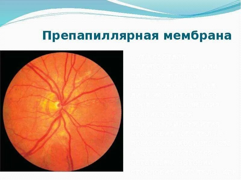 Врожденные аномалии ДЗН. Врожденная патология зрительного нерва. Врожденная аномалия диска зрительного нерва. Презентация на тему врожденные аномалии зрительного нерва.