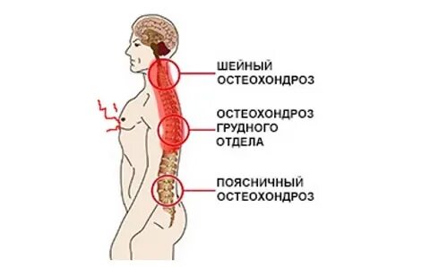 Лечение обострения шейного остеохондроза у женщин