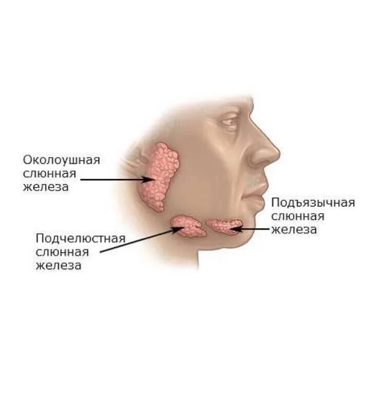 Слюнотечение у взрослых. Полиморфная аденома околоушной железы.