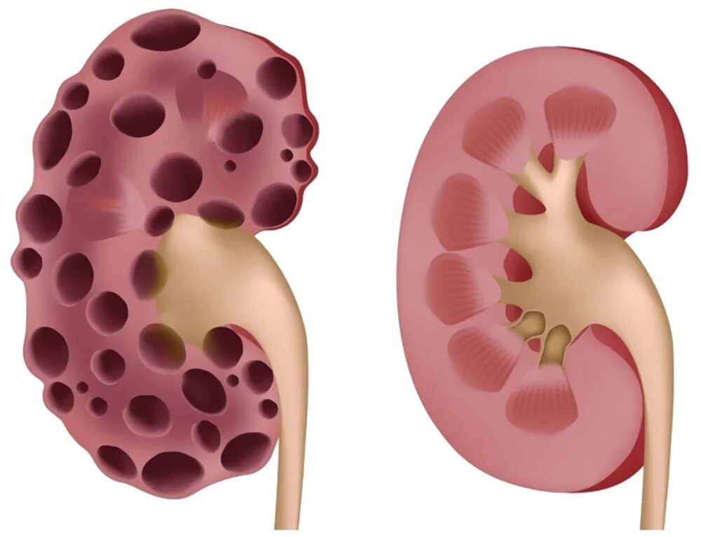 Поликистоз почек синдромы. Хронический пиелонефрит поликистоз почек. Острый двусторонний пиелонефрит.