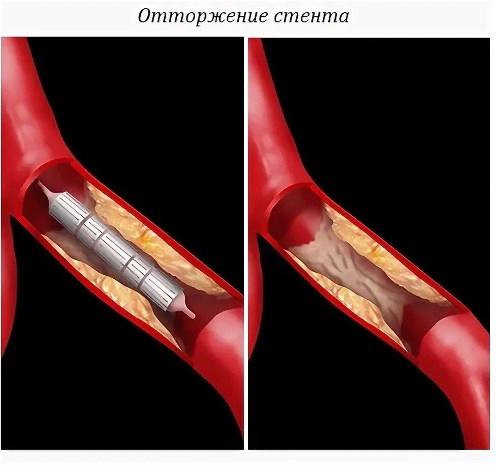 Замена стентов. Операция стентирование сосудов сердца. Стентирование подключичной артерии. Рестеноз коронарных артерий после стентирования.