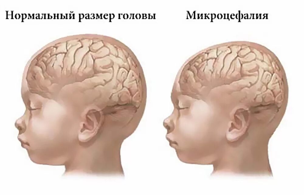 Мозг новорожденного масса. Микроцефалия гидроцефалия. Микроцефалия неврология. Олигофрения микроцефалия.