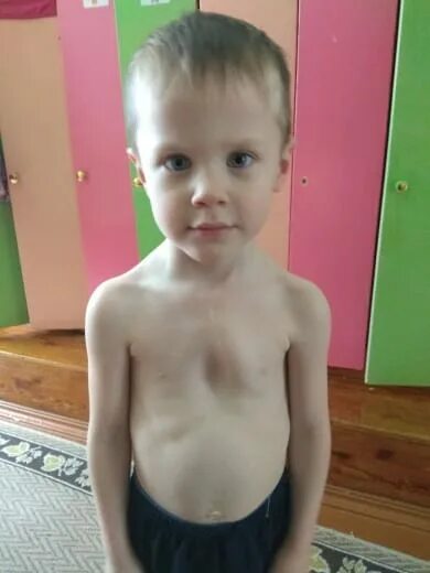 Ребенок 1 2 грудная клетка. Ребенок 1 2 грудная клетка. 6. Воронкообразная грудная клетка у ребенка. Ребенок 1 2 грудная клетка.