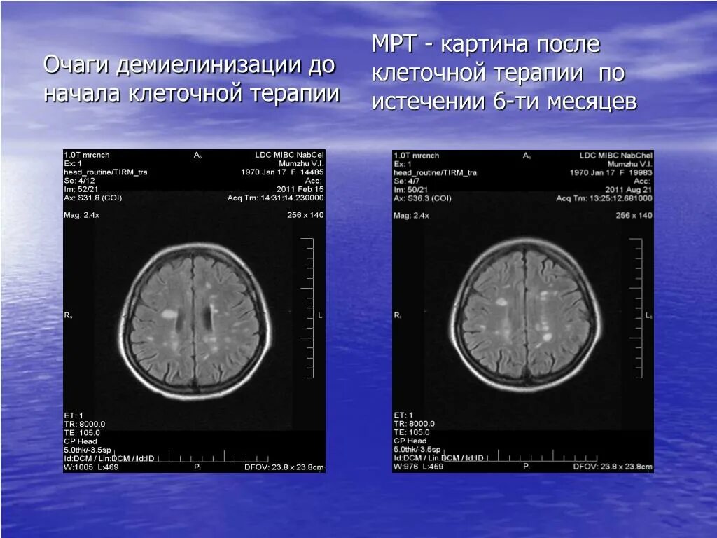 Очаги демиелинизации на мрт. Очаги демиелинизации головного мозга на мрт. Очаги демиелинизации генеза. Множественные очаги демиелинизации.