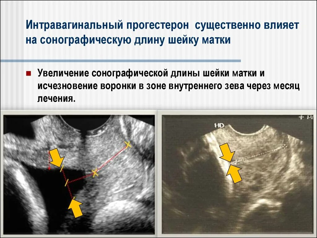 Почему укорачивается матка. УЗИ шейки матки цервикометрия. Измерение шейки матки на УЗИ. Раскрытие внутреннего зева.