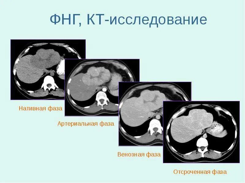 Узловая гиперплазия печени. Фокальная нодулярная гиперплазия печени на кт. Узловая гиперплазия печени кт. Фокальная Узловая гиперплазия печени кт. Фибронодулярная гиперплазия печени на кт.