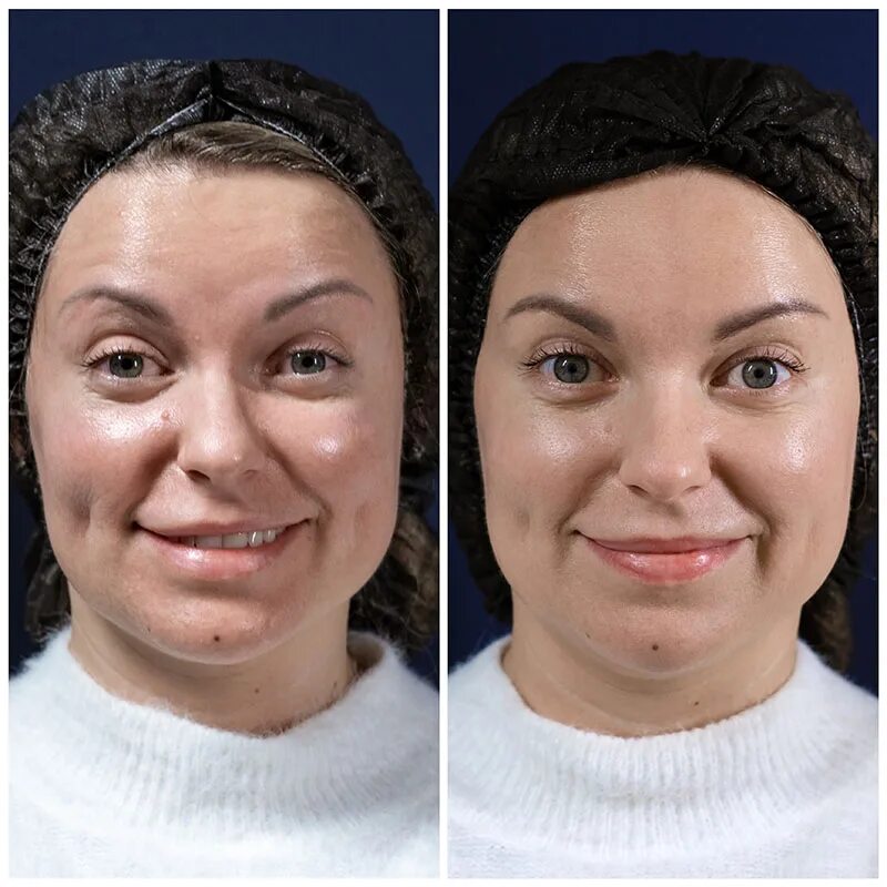 Ботулинотерапия лица отзывы. Ботулинотерапия Full face. Лицо после ботулинотерапии. Ксеомин Full face. Ботулинотерапия исправляет ассиметрию лица.