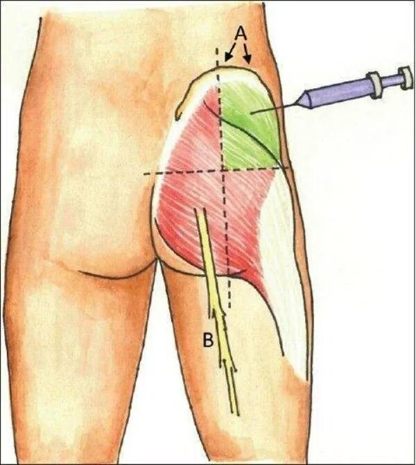 Как не больно сделать укол в ягодицу. Укол в верхний наружный Квадрант ягодицы. Внутримышечная инъекция верхний Квадрант. Место укола внутримышечно в ягодицу. Как правильно делать внутримышечный укол в ягодицу.