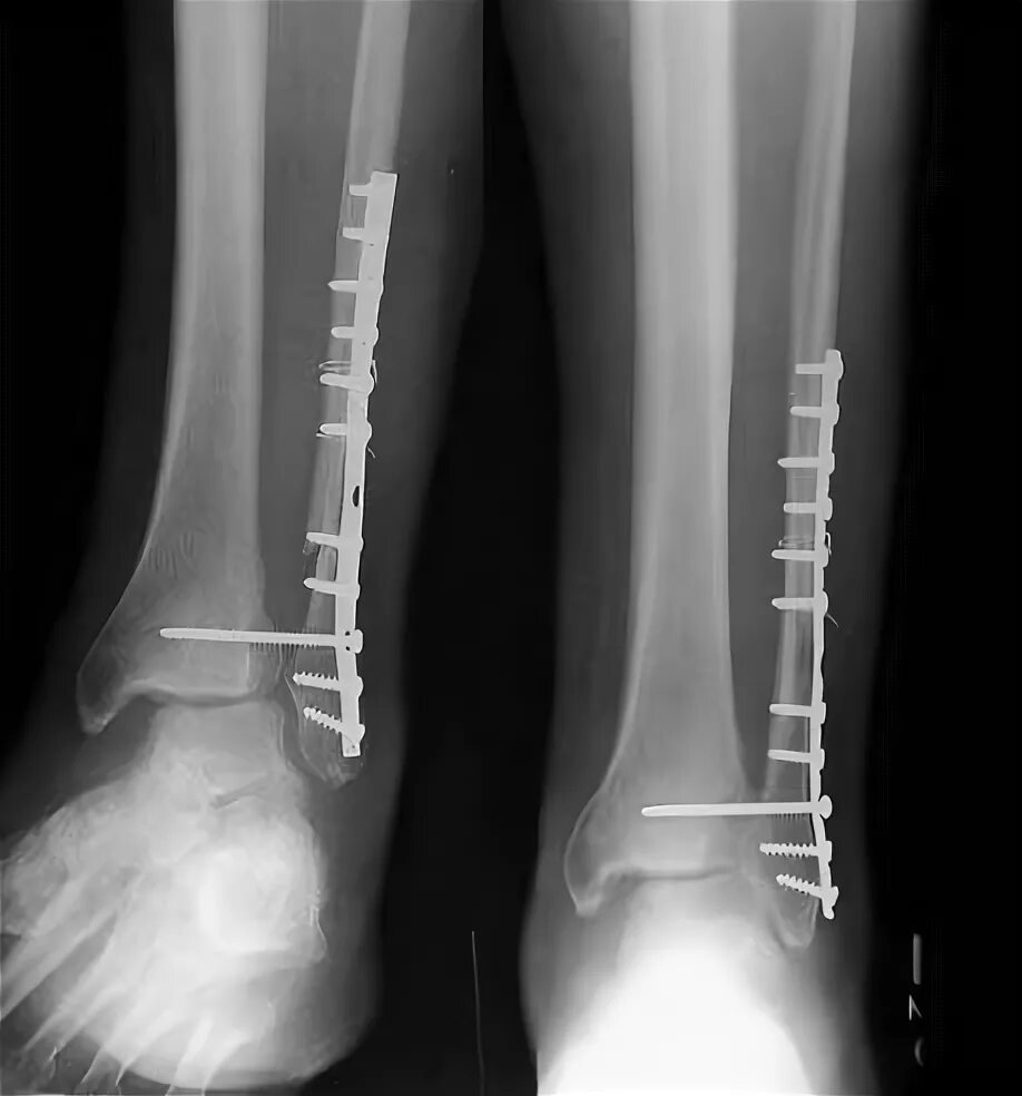 Дистальный разрыв. Синдесмоз голеностопного сустава. Остеосинтез межберцового синдесмоза. Повреждение синдесмоза голеностопного сустава рентген.