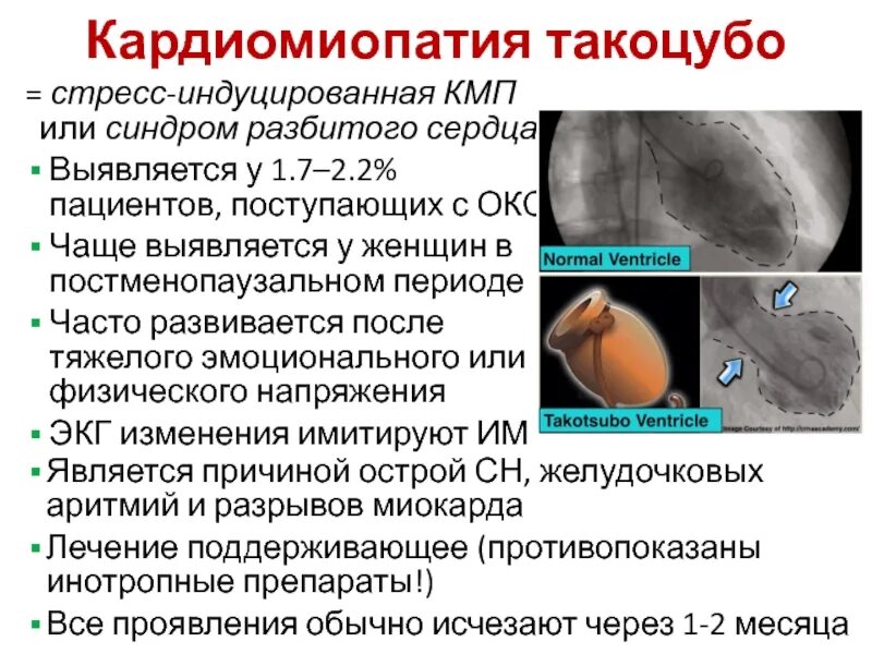 Синдром разбитого сердца симптомы. Кардиомиопатия такоцубо. синдром такоцубо экг.