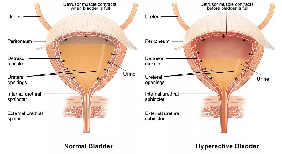 Мочевой пузырь. Детрузор мочевого. Гиперактивность детрузора. Мышца детрузор мочевого пузыря. Детрузор мочевого пузыря это