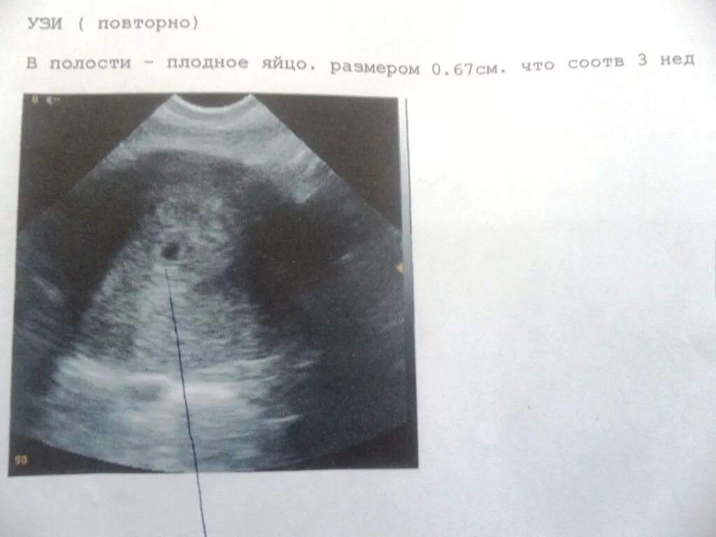 Тест показал а узи нет. Узи беременность 2 плодных яйца. плодное яйцо на 2 недели беременности. на 3 день задержки плодное яйцо 3 мм. тест на беременность 2 3 недели узи беременность.