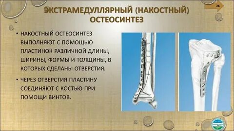 Травматология переломы презентация