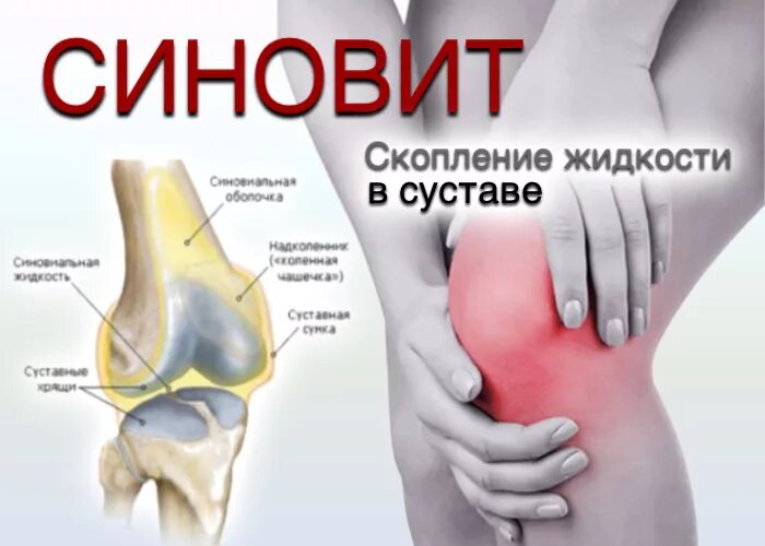 Синовит это