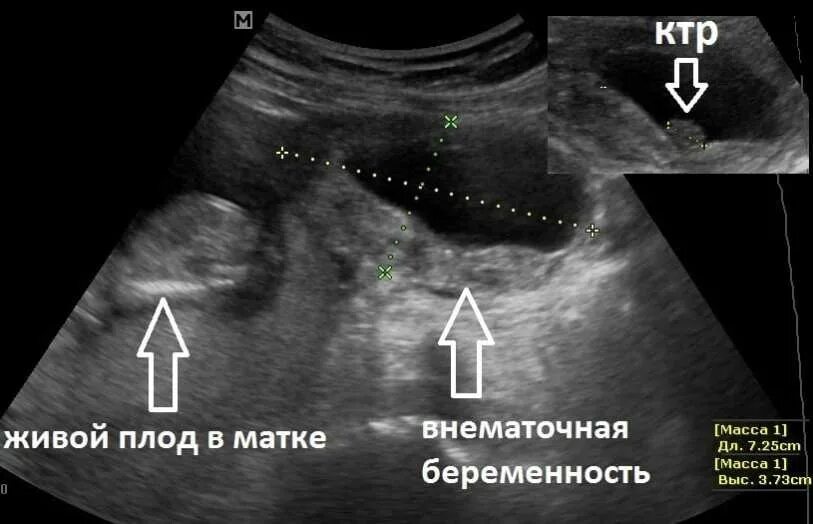 Когда можно увидеть беременность. Внематочная беременность в трубе УЗИ. Внематочная Трубная беременность УЗИ. Маточная и внематочная беременность УЗИ. Разрыв маточной трубы на УЗИ.
