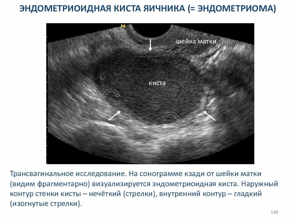 Эндометриомы яичников. Эндометриоидная киста шейки матки на УЗИ. УЗИ заключение эндометриоидная киста правого яичника. Киста яичника эндометриома.