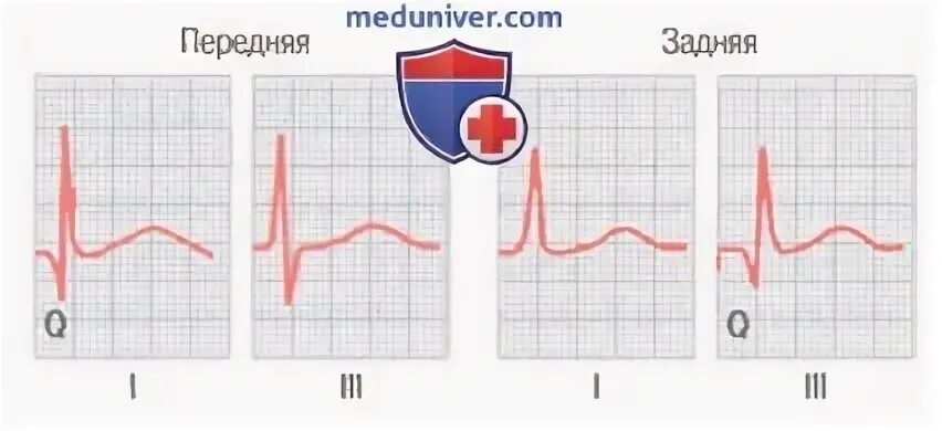 Уплощенный зубец т на ЭКГ. Снижена амплитуда зубца т в переднебоковых отведениях. Инверсия зубца т. Сглаженный зубец т. Нарушение реполяризации передне перегородочной области