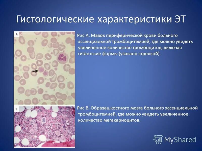 Стадии развития тромбоцитов. Образование тромбоцитов из мегакариоцитов. Тромбоцитемия симптомы. Строение тромбоцита гистология. Эссенциальная тромбоцитопения.
