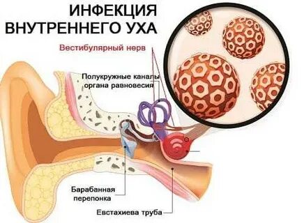Вестибулярный нейронит