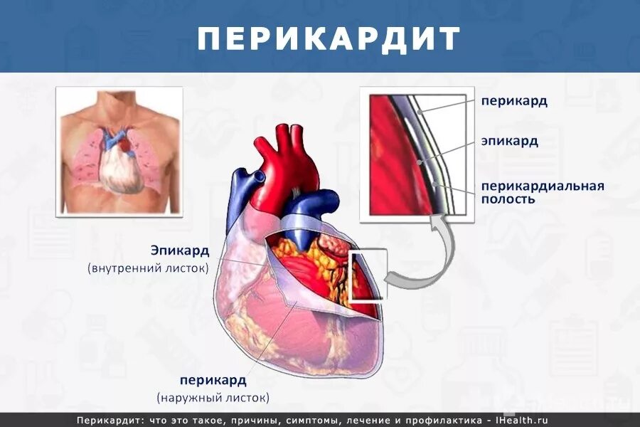 Перикардит симптомы и лечение. Перикардит (воспаление наружной сердечной оболочки). Острый сердечный перикардит. Что такое перикардит сердца симптомы. Перикард сердца заболевания.