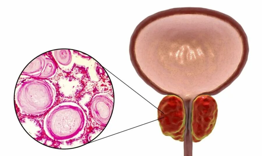 Гиперплазия предстательной железы препараты. Доброкачественная гиперплазия предстательной железы (ДГПЖ). Аденома предстательной железы (аденома простаты). Фиброз предстательной железы.