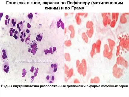Диплококки в мазке у женщин