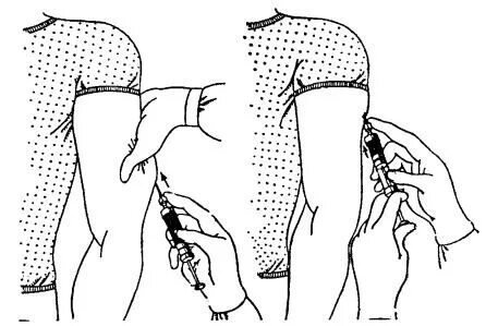 Внутримышечная инъекция в лечо. Техника введения лекарственных средств внутримышечно подкожно. Введение вакцины в дельтовидную мышцу. Укол в плечо внутримышечно техника. Как правильно сделать укол в плечо.