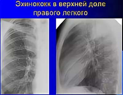 Эхиноккоз