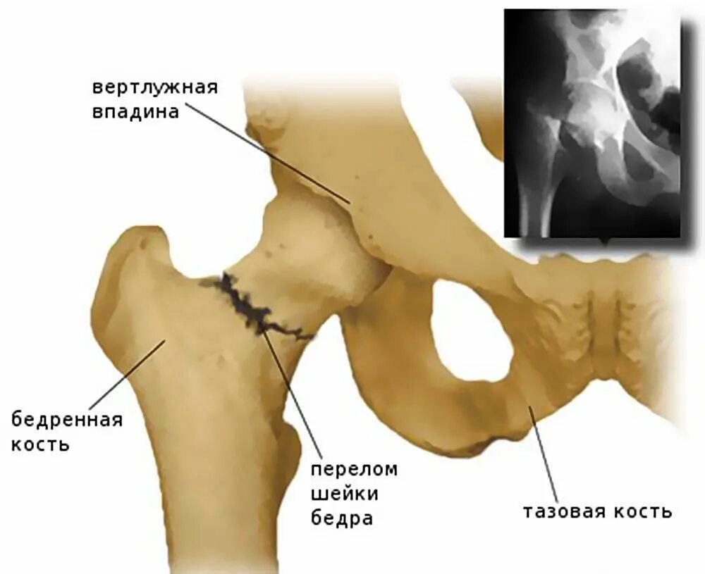 Перелом шейки бедра в пожилом возрасте. Медиальный перелом шейки бедра. Вертлужная впадина тазобедренного сустава анатомия. Субкапитальный перелом шейки бедра. Вертлужная кость тазобедренного сустава.