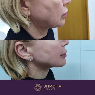 Платизмопластика шеи отзывы