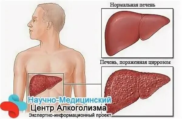 Лечение алкогольного цирроза печени