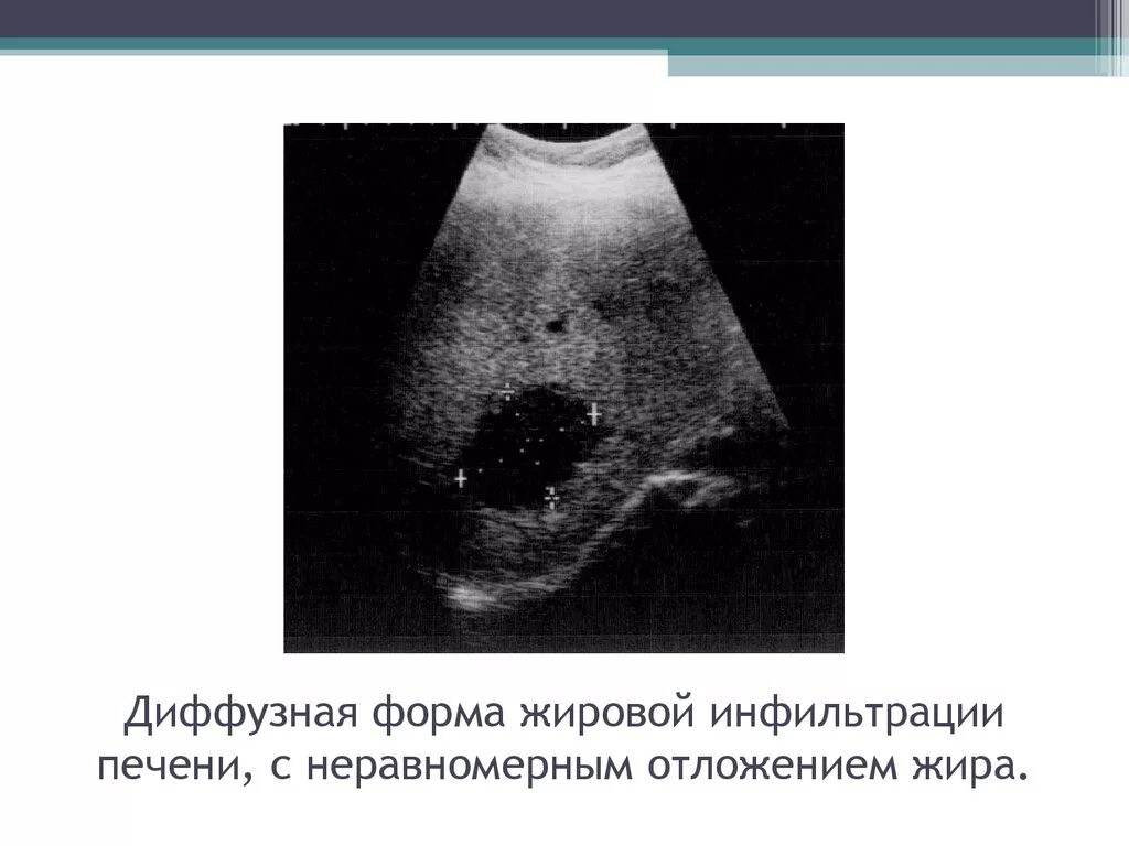 Хронические диффузные изменения печени. Очаговая жировая инфильтрация печени на УЗИ. Жировой гепатоз очаговая форма на УЗИ. Жировая инфильтрация печени УЗИ заключение. Жировой гепатоз печени при УЗИ.