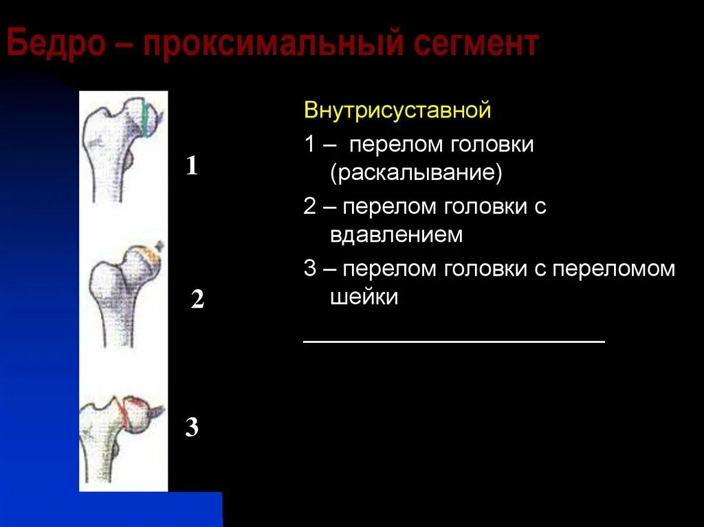 Проксимальной слабости. Перелом проксимального отдела бедренной кости. Переломы проксимального отдела бедра. Проксимальный сегмент бедра. Переломы проксимального отдела бедренной кости у детей.