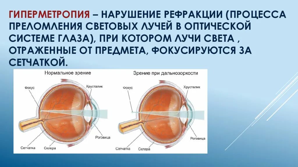 Миопия что это такое у детей. Дальнозоркость и близорукость строение глаза. Миопия гиперметропия астигматизм. Строение глаза при дальнозоркости. Патология рефракции гиперметропия.