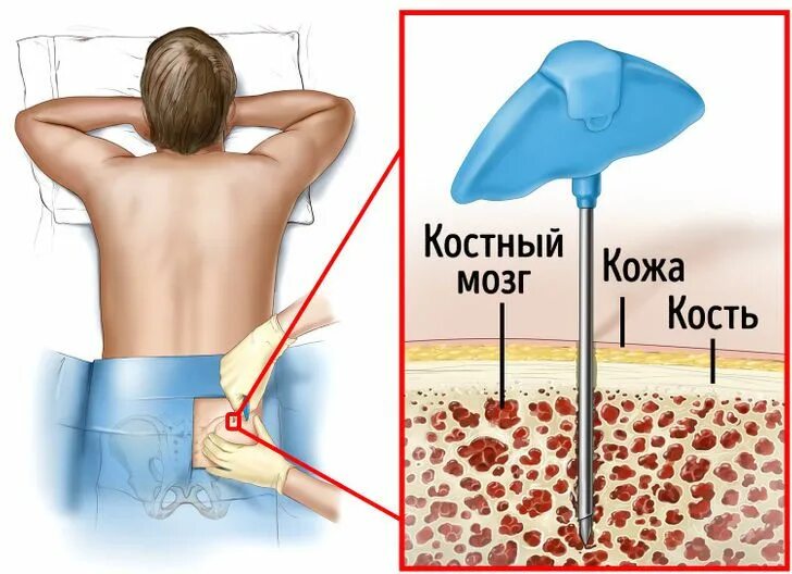 Пересадка костного мозга москва. Трепанобиопсия костного мозга. Пересаживание костного мозга. Трансплантация костного мозга. Пересадка ко тногомозга.