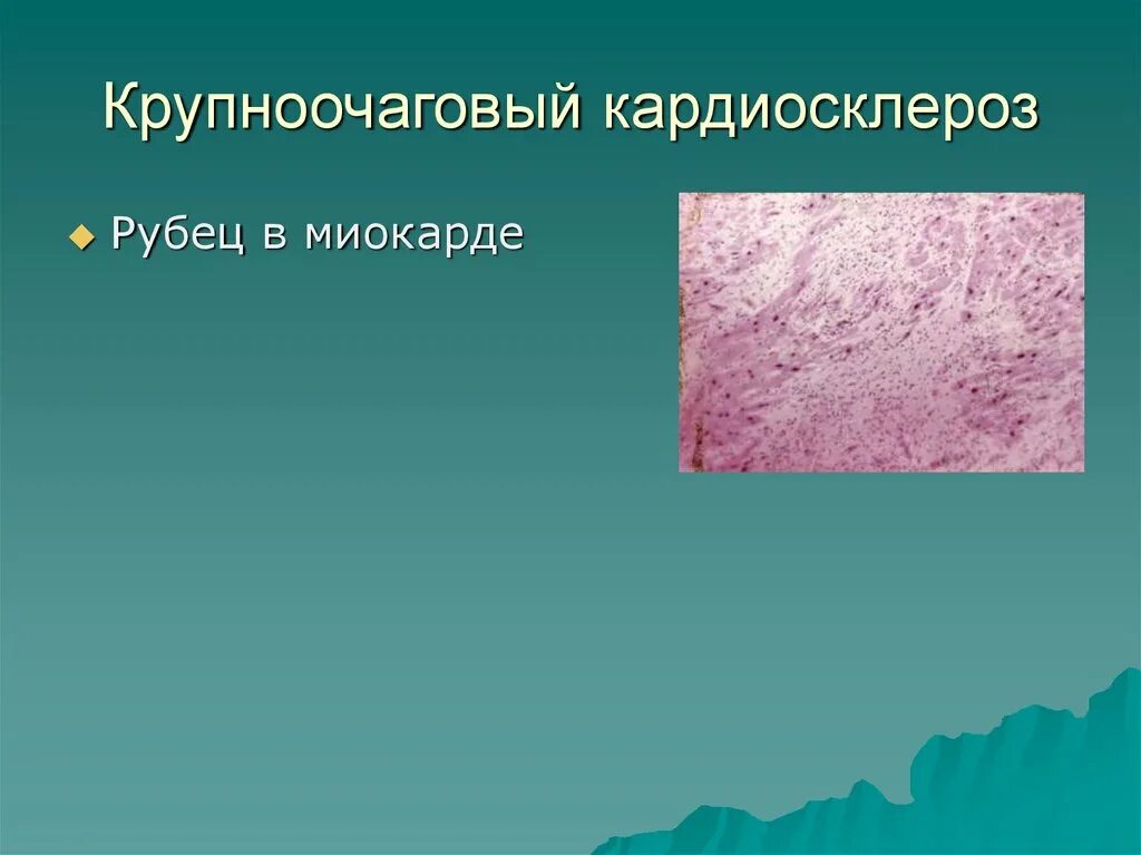 Крупноочаговый кардиосклероз. Крупноочаговый кардиосклероз микропрепарат. кардиосклероз метаплазия. атрофия - гипертрофия - гиперплазия - метаплазия.