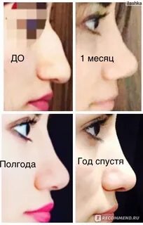 Ринопластика отек сколько