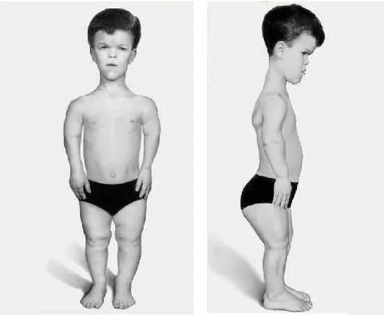 Раннее половое развитие у девочек. Синдром шерешевского-тернера пубертатный период. Синдром роста у детей. Синдром роста у детей. Гипофизарная карликовость гормона заболевание.