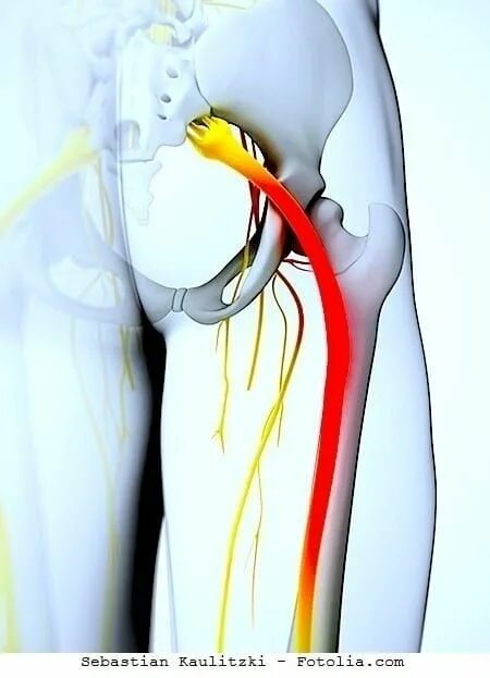 Тейп на седалищный нерв. Седалищный нерв (sciatic nerve)? 011. Тейпирование седалищного нерва. Защемление седалищного нерва тейпирование.