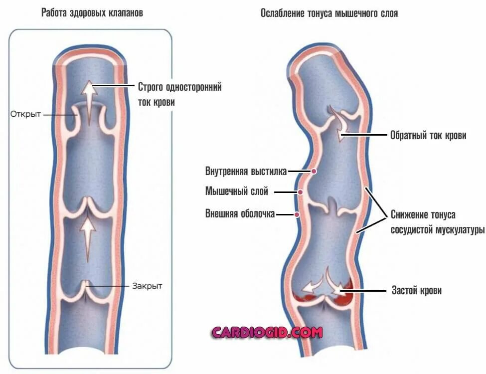 Строение вен нижних конечностей клапаны. Строение венозного клапана. Схема действия венозных клапанов. Признаки клапанной недостаточности вен нижних конечностей. Вены ног клапаны