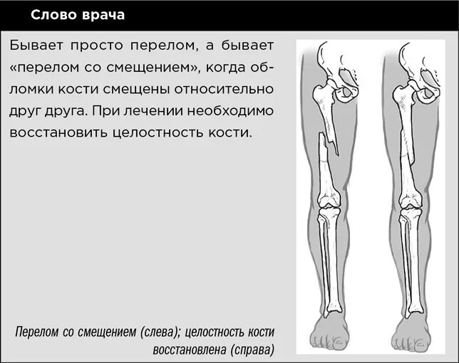 Закрытом переломе со смещением костей необходимо:. Открытом переломе со смещением костей необходимо. При закрытом переломе со смещкнием кочтей неоьзодимо. При открытом переломе со смещением кости необходимо:. При открытом переломе необходимо ответ