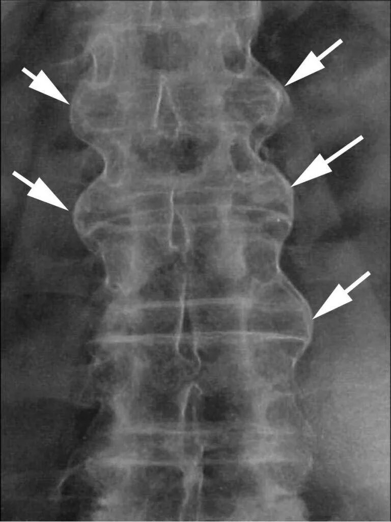 Спондилеза спондилоартроза поясничного отдела позвоночника. Спондилез с4- с6. Деформирующий спондилез l1-l3. Спондилез шейного отдела рентген. Спондилез позвоночника рентген.