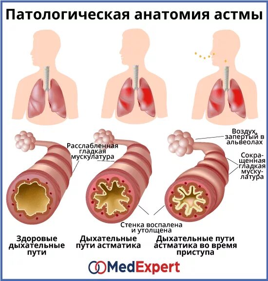 Бронхиальная астма патологическая анатомия симптомы. Атопическая аллергическая бронхиальная астма симптомы. 1 Стадия бронхиальной астмы. Бронхиальная астма с аллергическим компонентом. Аллергия и бронхит