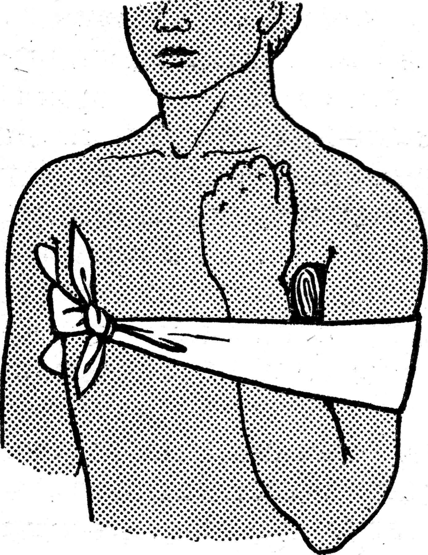 Наложение жгута и повязки. Наложение бинтовых повязок на шею. Наложение жгута и давящей повязки. Остановка кровотечения из локтевой артерии.