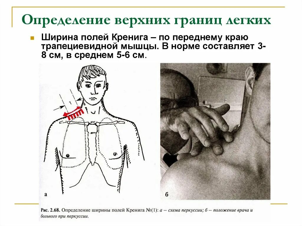 Ширина полей Кренига перкуссия. Топографическая перкуссия легких поля Кренига. Топографическая перкуссия легких верхняя граница. Границы легких определяются