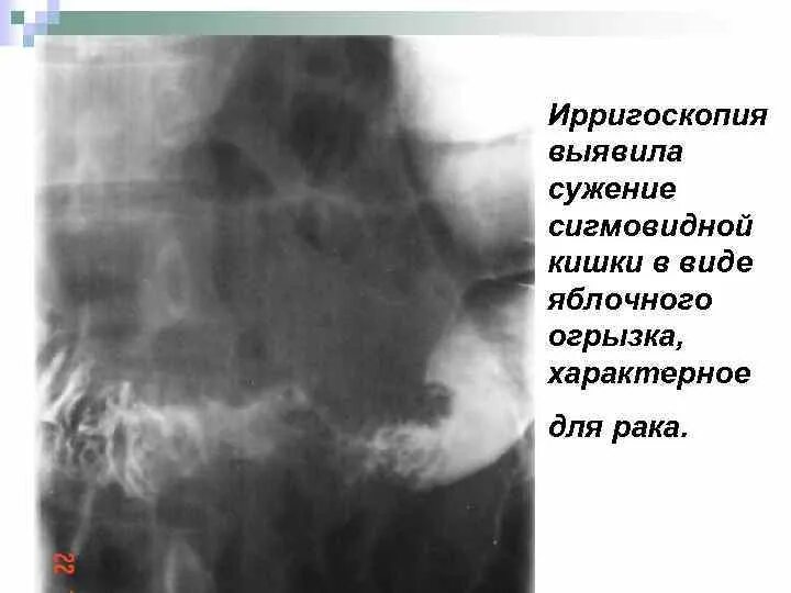 Опухоль сигмовидной кишки рентген. Ирригоскопия опухоль сигмовидной кишки. Синдром раздраженного кишечника рентген. Сужение сигмовидной кишки рентген. Стеноз прямой